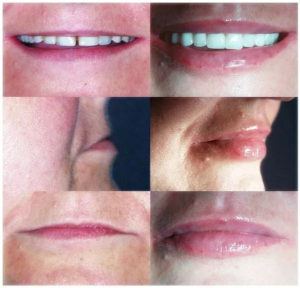 Jak długo utrzymuje się efekt powiększania ust kwasem hialuronowym?