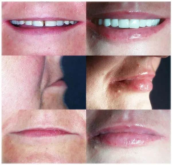 Jak długo utrzymuje się efekt powiększania ust kwasem hialuronowym?