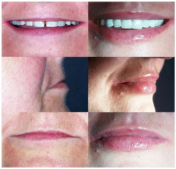 Jak długo utrzymuje się efekt powiększania ust kwasem hialuronowym?