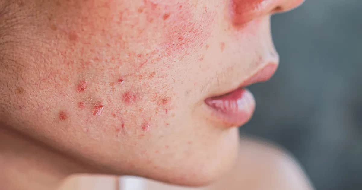 Cera trądzikowa co stosować, aby skutecznie zwalczyć trądzik