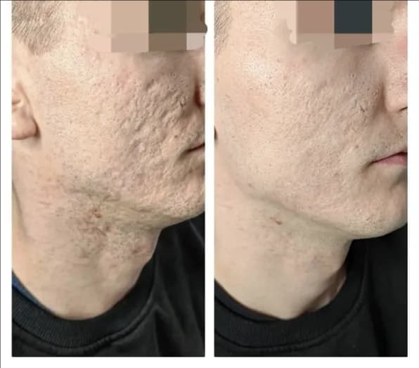 Kiedy można myć twarz po laserze frakcyjnym, aby uniknąć problemów?