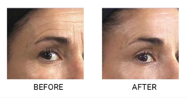 Endermologia twarzy na czym polega - skutki i korzyści zabiegu