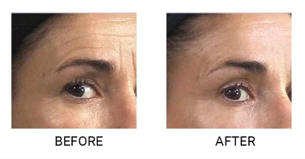 Endermologia twarzy na czym polega - skutki i korzyści zabiegu