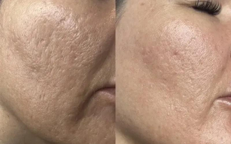 Ile kosztuje laser frakcyjny? Ceny zabiegów w Polsce i różnice