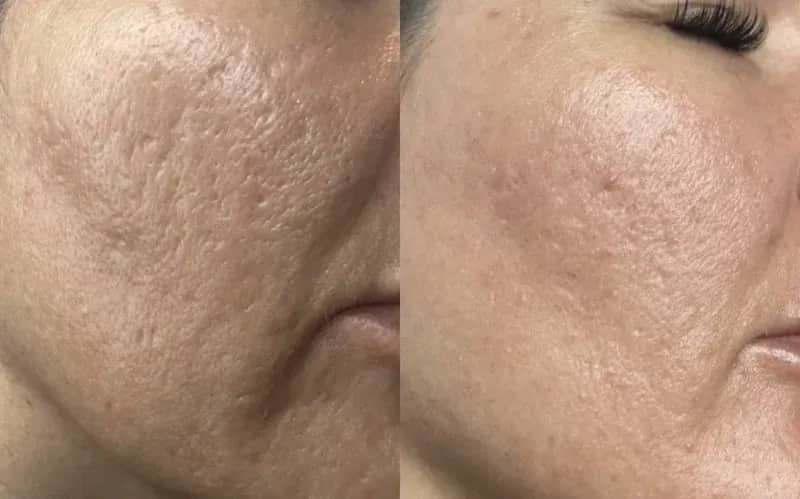 Ile kosztuje laser frakcyjny? Ceny zabiegów w Polsce i różnice