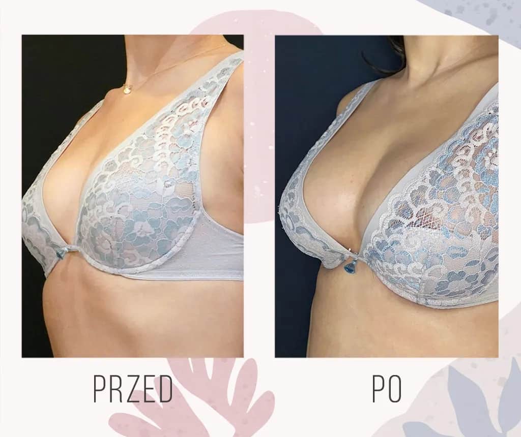 Ile kosztuje powiększenie biustu w Niemczech? Sprawdź, co wpływa na cenę