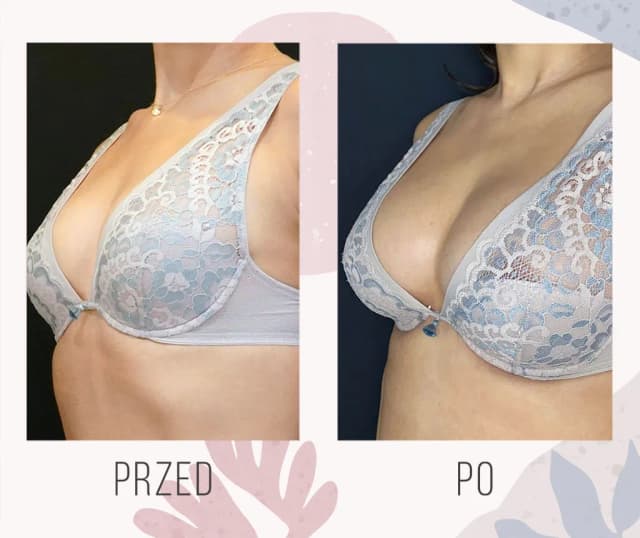 Ile kosztuje powiększenie biustu w Niemczech? Sprawdź, co wpływa na cenę